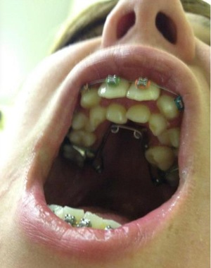 أساليب العلاج Hyperdontics