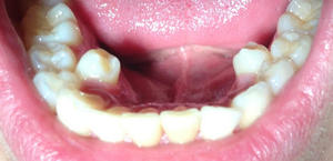 منع Hyperdontics